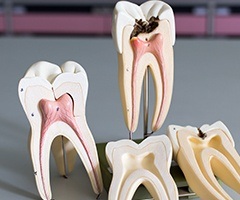Models of inside of the tooth